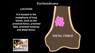 Enchondroma  Everything You Need To Know  Dr Nabil Ebraheim [upl. by Cirdet442]