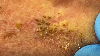 Extreme Blackhead Extraction Summer Throwback  CONTOUR DERMATOLOGY [upl. by Essam344]