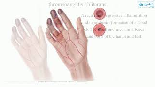 thromboangiitis obliterans [upl. by Spiers]