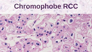 Chromophobe Renal Cell Carcinoma [upl. by Naret]