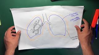 Managing Malignant Pleural Effusions Pleurodesis [upl. by Iddet]