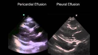 Cardiac Ultrasound Pericardial vs Pleural effusion [upl. by Ennagem]