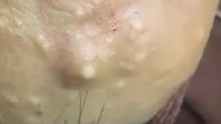 LARGE Blackheads Removal  Satisfying Blackhead 2019 [upl. by Guadalupe101]