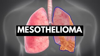 MESOTHELIOMA Causes Signs and Symptoms Diagnosis and Treatment [upl. by Ettenor]