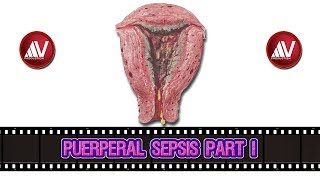 Puerperal Sepsis Part I [upl. by Aidekal69]