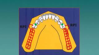 Diseño de Prótesis Parcial Removible [upl. by Enomed836]