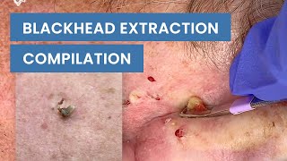 Extraction Satisfaction Blackhead Removal  CONTOUR DERMATOLOGY [upl. by Henson431]