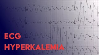 Hyperkalemia EKG Findings  ECG Interpretation [upl. by Theone490]