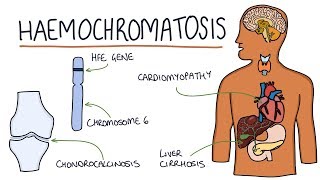 Understanding Haemochromatosis [upl. by Riba]