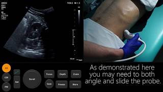 Ultrasound Tutorial Kidney amp Bladder  Urinary Tract  Radiology Nation [upl. by Savvas]