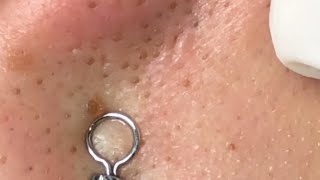 Super Deep Blackheads Removal from Nose  Acne Treatment 32 [upl. by Weintrob]