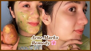 7 days Challenge  Remove Acne scars  Marks  soft and healthy Skin [upl. by Aleuqahs407]