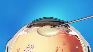 Phacoemulsification Cataract Surgery [upl. by Aennyl90]