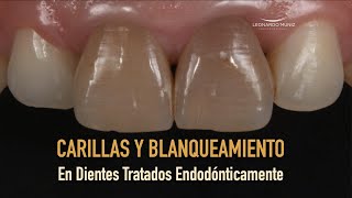 Carillas y blanqueamiento en dientes tratados endodónticamente [upl. by Pasadis]