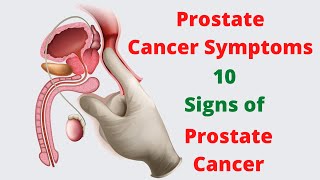 Radiation for Prostate Cancer and Prostatitis Symptoms  Ask a Prostate Expert Mark Scholz MD [upl. by Ennaecarg305]