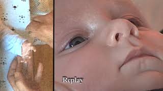 Baby – Palmomental reflex PMR [upl. by Ecinahc477]