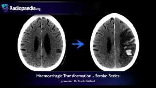 Two Types of Stroke Know the Symptoms [upl. by Thanos]