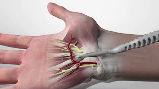 Handtherapie na de operatie Carpaal tunnel syndroom [upl. by Niliram]