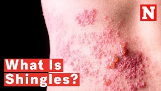 What Is Shingles [upl. by Allehc503]