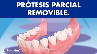 Prótesis parcial removible  ¿Cómo funcionan © [upl. by Tebzil]