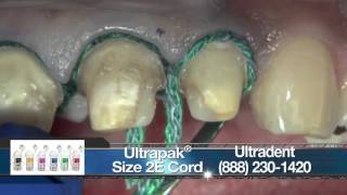 Replacing Crowns on Teeth 710 With BruxZir® Anterior [upl. by Dona957]