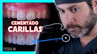 👉COMO se ponen las 𝘾𝘼𝙍𝙄𝙇𝙇𝘼𝙎 𝙙𝙚 𝙋𝙊𝙍𝘾𝙀𝙇𝘼𝙉𝘼 en los dientes Te lo explico FÁCIL  COMPRUEBALO✅ [upl. by Kaylil]