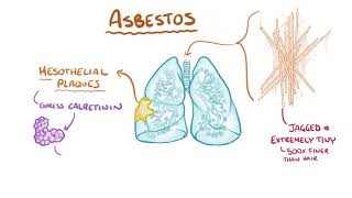 Mesothelioma causes symptoms diagnosis treatment pathology [upl. by Trocki]