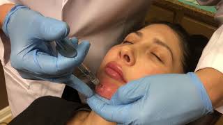 NonSurgical Chin Augmentation using Juvederm Voluma 3cc [upl. by Tongue]