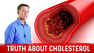 The Truth About Cholesterol – LDL Cholesterol amp HDL Cholesterol – DrBerg [upl. by Shah186]