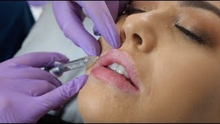 Lip Fillers  what to expect during the procedure  The Laser amp Skin Clinic [upl. by Latouche834]