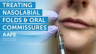 Using Dermal Fillers to Fill and Smooth Smile Lines  AAFE [upl. by Treblihp]