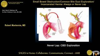 Common bile duct exploration Never laparoscopically [upl. by Arraeic]