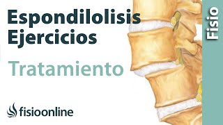 Espondilolisis y espondilolistesis  Tratamiento con ejercicios automasajes y estiramientos [upl. by Brande]