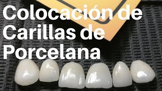 COLOCACIÓN de CARILLAS de Porcelana👅carillasdentales [upl. by Millan]