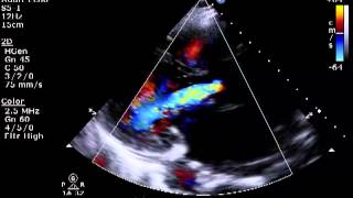 Aortic amp Mitral Regurgitation [upl. by Daitzman]