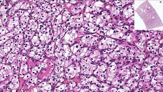 Clear Cell Renal Cell Carcinoma  Histopathology [upl. by Arretal]