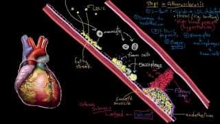 Atheroma in the artery [upl. by Ulrick]