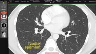 Lobar and Segmental Lung Anatomy on CT [upl. by Tiphanie]