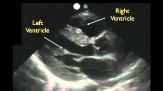 Cardiac Ultrasound  Parasternal Long Axis  Part 1  Sonosite Inc [upl. by Josh]