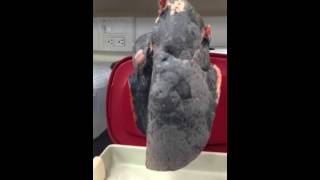 Smokers Lungs vs Healthy Lungs Video [upl. by Akilak528]