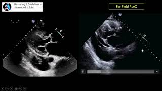 Transthoracic Echocardiography Parasternal Views [upl. by Margaret]