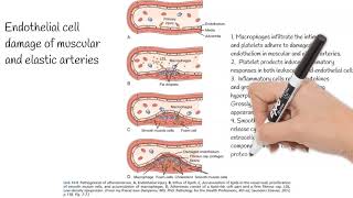 Atherosclerosis  Causes Pathogenesis Prevention [upl. by Crawley]