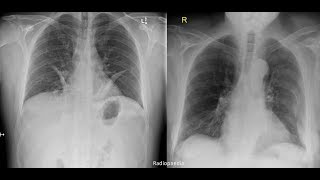 Hemothorax pneumothorax pleural effusion [upl. by Panchito]