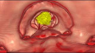 Foramen Magnum Meningioma [upl. by Cid]