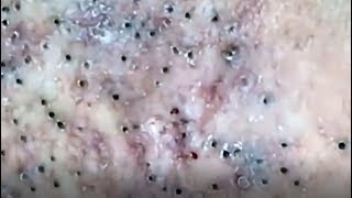 Blackheads removal from face  blackhead removal  acne 2019 [upl. by Bala]