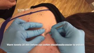 Blackheads back removal  the Australian Anaconda [upl. by Bores]