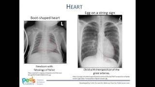 pleural effusion vs atelectasis [upl. by Elsi]