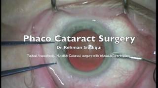 Phaco Cataract Surgery High Definition HD [upl. by Annaor]