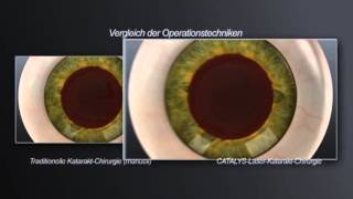 Informationsvideo zur Operation des Grauen Stars mit Laser [upl. by Nanah152]