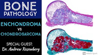 Chondrosarcoma vs Enchondroma Bone Pathology with Dr Andrew Rosenberg [upl. by Whitcher]